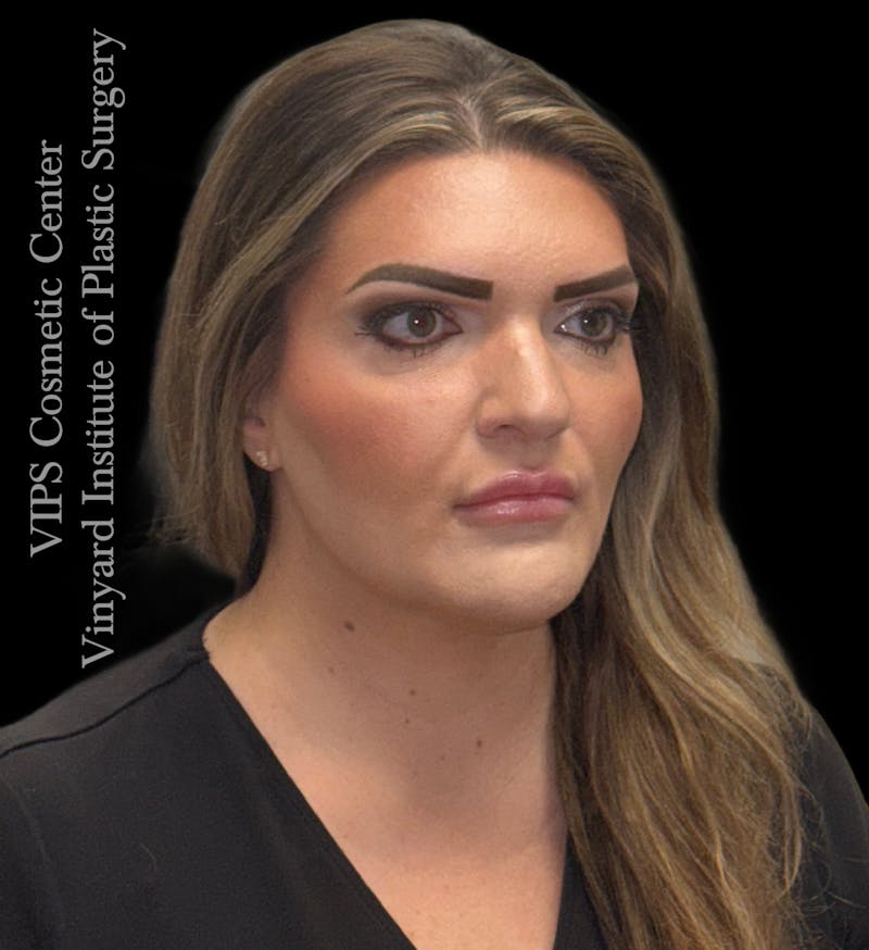 Dermal Fillers Before & After Gallery - Patient 244956 - Image 3