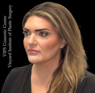 Dermal Fillers Before & After Gallery - Patient 244956 - Image 6