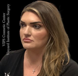 Dermal Fillers Before & After Gallery - Patient 244956 - Image 6