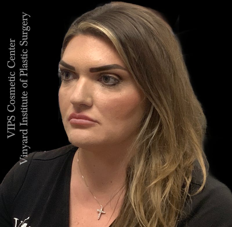 Dermal Fillers Before & After Gallery - Patient 244956 - Image 6