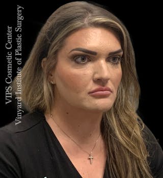 Dermal Fillers Before & After Gallery - Patient 244956 - Image 4