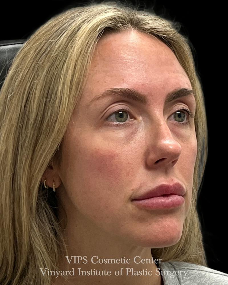 Sculptra Before & After Gallery - Patient 228865 - Image 3