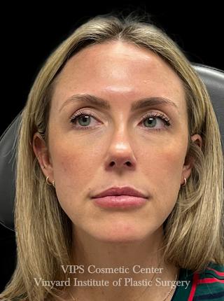 Sculptra Before & After Gallery - Patient 228865 - Image 2