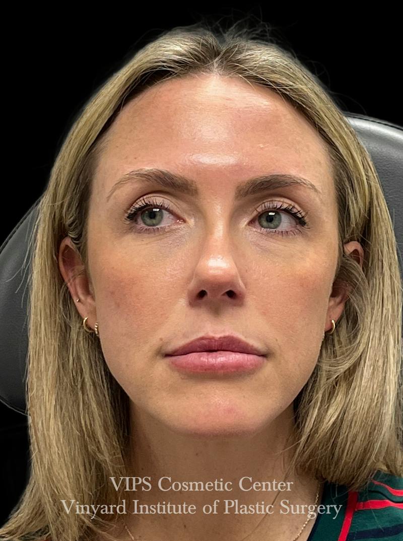 Sculptra Before & After Gallery - Patient 228865 - Image 2