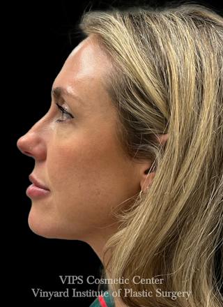 Sculptra Before & After Gallery - Patient 228865 - Image 6