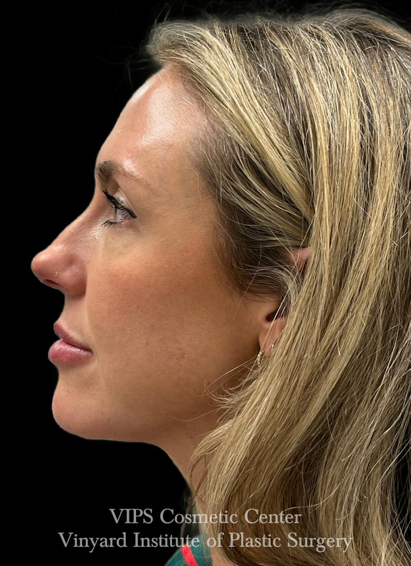 Sculptra Before & After Gallery - Patient 228865 - Image 6