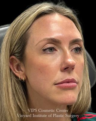 Sculptra Before & After Gallery - Patient 228865 - Image 4