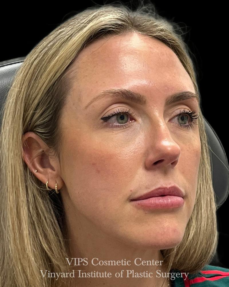 Sculptra Before & After Gallery - Patient 228865 - Image 4