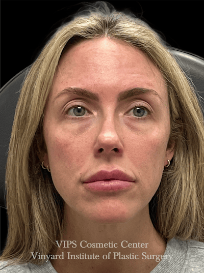 Sculptra Before & After Gallery - Patient 228865 - Image 1
