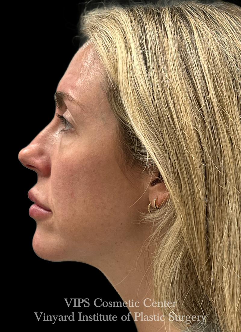 Sculptra Before & After Gallery - Patient 228865 - Image 5