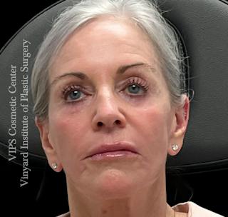 Sculptra Before & After Gallery - Patient 283510 - Image 2