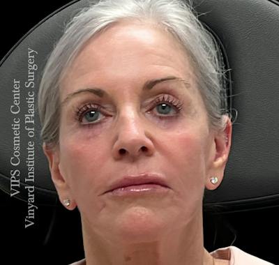 Sculptra Before & After Gallery - Patient 283510 - Image 2