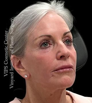 Sculptra Before & After Gallery - Patient 283510 - Image 4