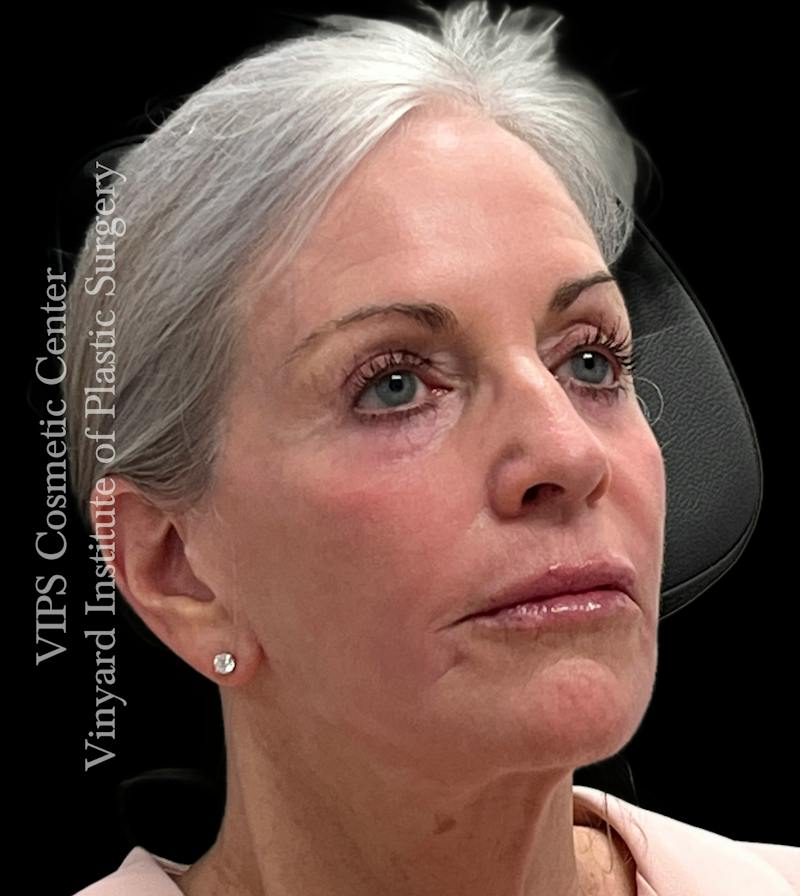 Sculptra Before & After Gallery - Patient 283510 - Image 4
