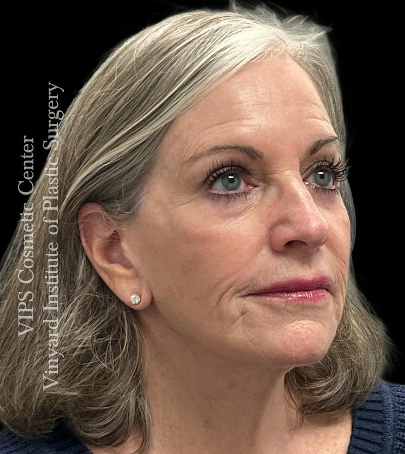 Sculptra Before & After Gallery - Patient 283510 - Image 3