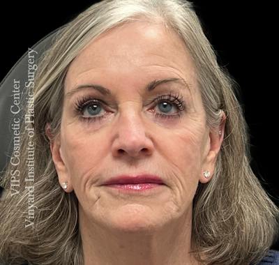 Sculptra Before & After Gallery - Patient 283510 - Image 1