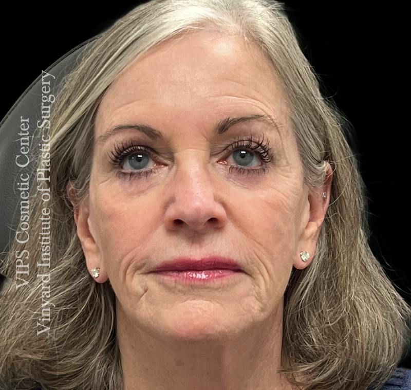 Sculptra Before & After Gallery - Patient 283510 - Image 1