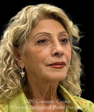 Sculptra Before & After Gallery - Patient 248250 - Image 4