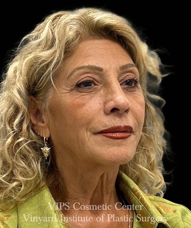 Sculptra Before & After Gallery - Patient 248250 - Image 4