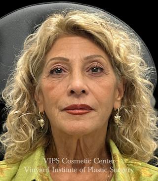 Sculptra Before & After Gallery - Patient 248250 - Image 2