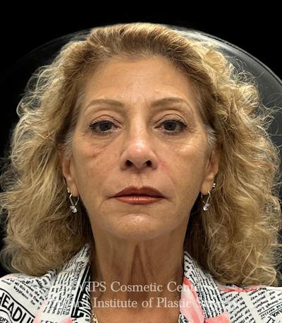 Sculptra Before & After Gallery - Patient 248250 - Image 1