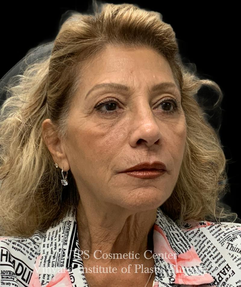 Sculptra Before & After Gallery - Patient 248250 - Image 3