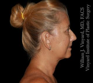 Facelift (Cheek and Neck Lift) Before & After Gallery - Patient 108589 - Image 6