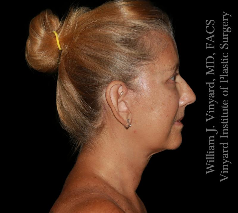 Facelift (Cheek and Neck Lift) Before & After Gallery - Patient 108589 - Image 6
