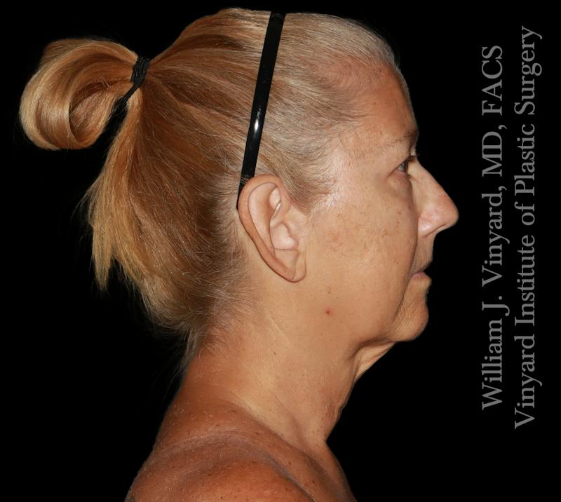 Facelift (Cheek and Neck Lift) Before & After Gallery - Patient 108589 - Image 5