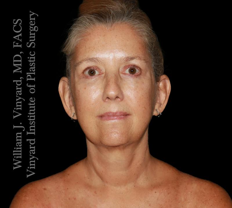 Facelift (Cheek and Neck Lift) Before & After Gallery - Patient 108589 - Image 2