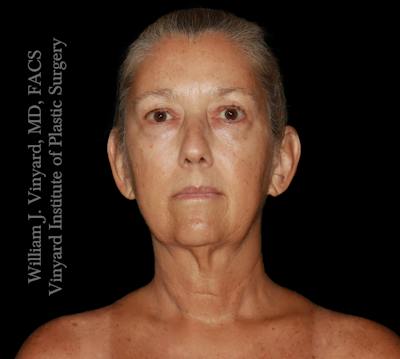 Facelift (Cheek and Neck Lift) Before & After Gallery - Patient 108589 - Image 1