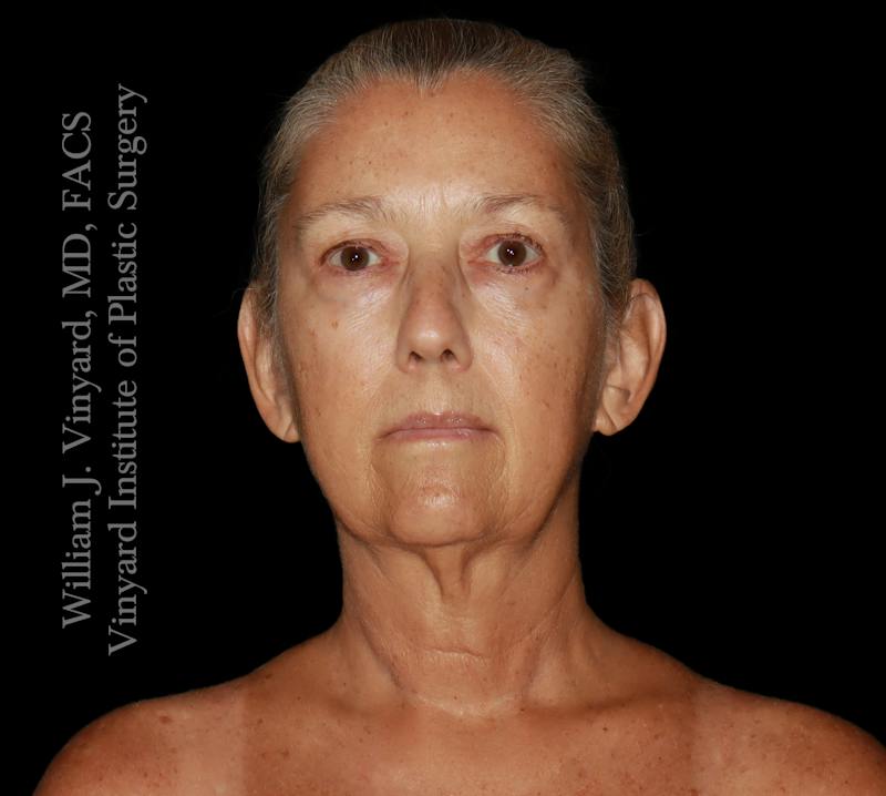 Facelift (Cheek and Neck Lift) Before & After Gallery - Patient 108589 - Image 1