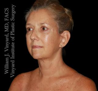 Facelift (Cheek and Neck Lift) Before & After Gallery - Patient 108589 - Image 8