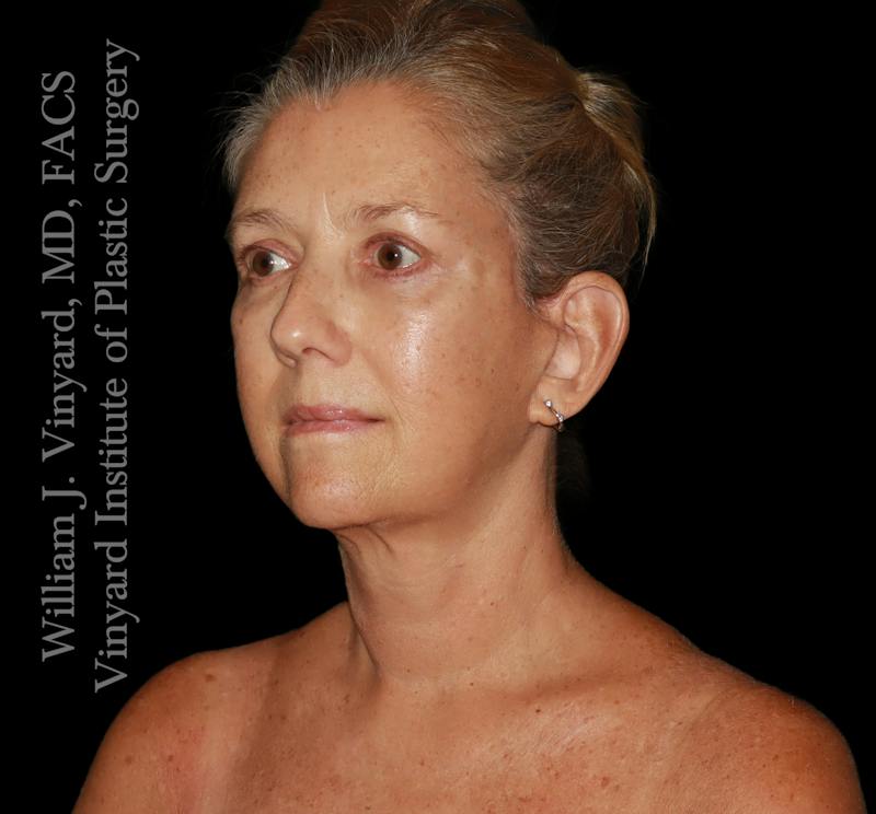 Facelift (Cheek and Neck Lift) Before & After Gallery - Patient 108589 - Image 8