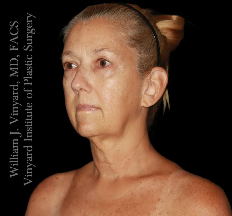 Facelift (Cheek and Neck Lift) Before & After Gallery - Patient 108589 - Image 7