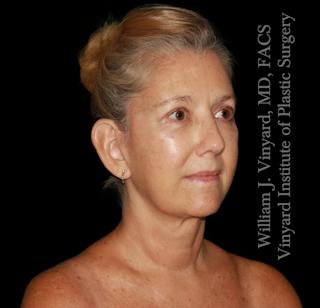 Facelift (Cheek and Neck Lift) Before & After Gallery - Patient 108589 - Image 4