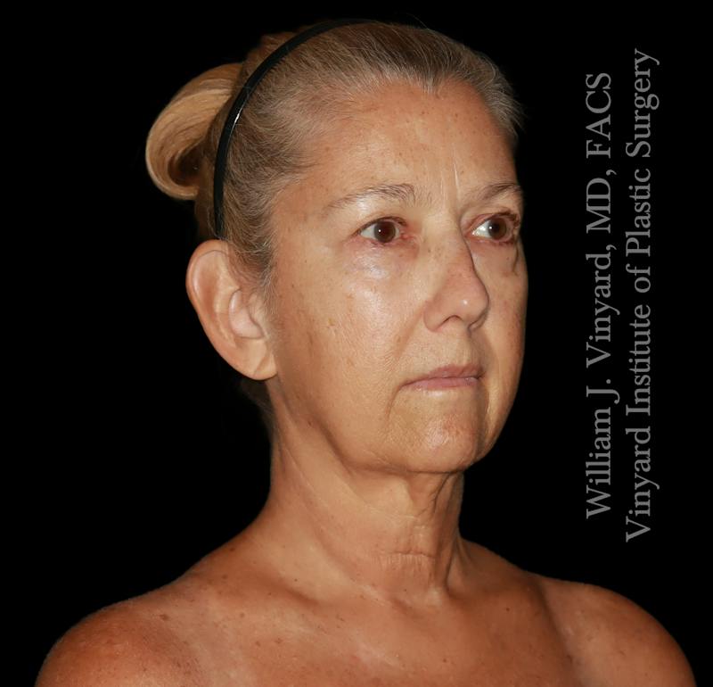 Facelift (Cheek and Neck Lift) Before & After Gallery - Patient 108589 - Image 3