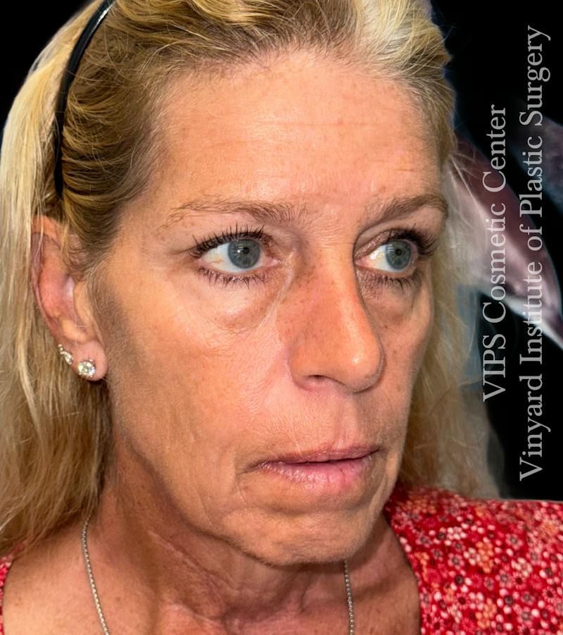 Elluminate Advanced Photofacial w/IPL Before & After Gallery - Patient 107722 - Image 3