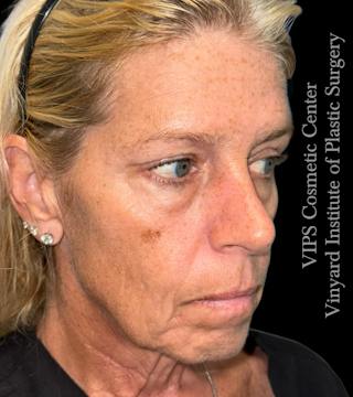 Elluminate Advanced Photofacial w/IPL Before & After Gallery - Patient 107722 - Image 4