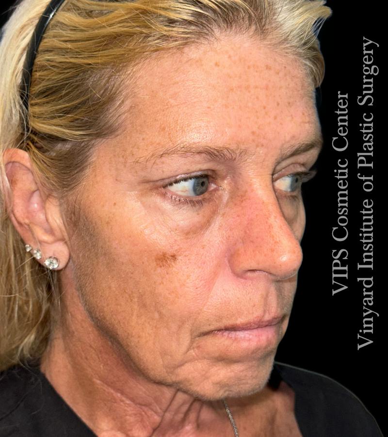 Elluminate Advanced Photofacial w/IPL Before & After Gallery - Patient 107722 - Image 4