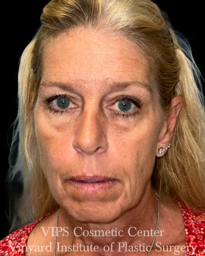 Elluminate Advanced Photofacial w/IPL Before & After Gallery - Patient 107722 - Image 1
