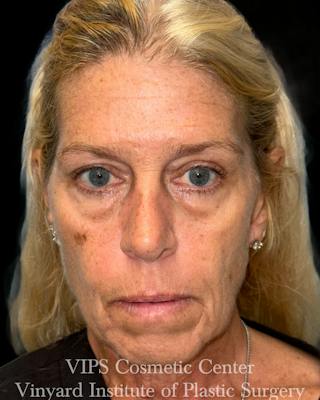 Elluminate Advanced Photofacial w/IPL Before & After Gallery - Patient 107722 - Image 2