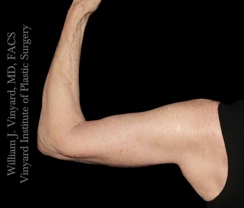 Arm Lift Before & After Gallery - Patient 189128 - Image 2