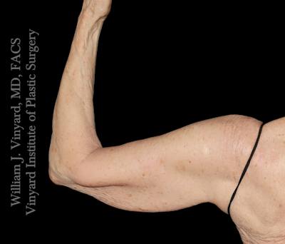 Arm Lift Before & After Gallery - Patient 189128 - Image 1