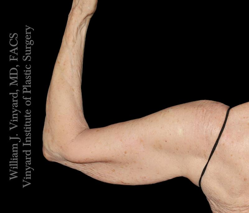 Arm Lift Before & After Gallery - Patient 189128 - Image 1
