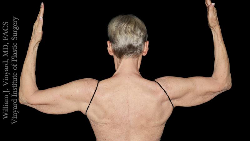 Arm Lift Before & After Gallery - Patient 189128 - Image 5