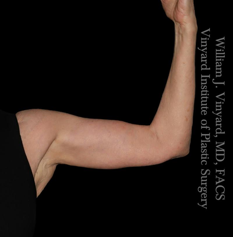 Arm Lift Before & After Gallery - Patient 189128 - Image 4