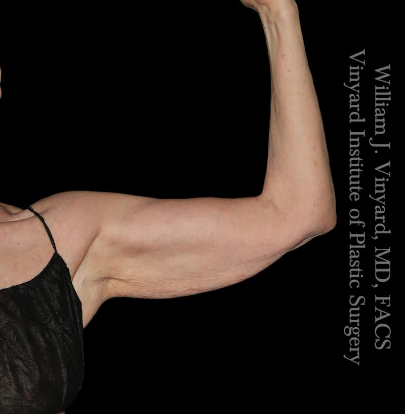 Arm Lift Before & After Gallery - Patient 189128 - Image 3