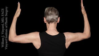 Arm Lift Before & After Gallery - Patient 189128 - Image 6
