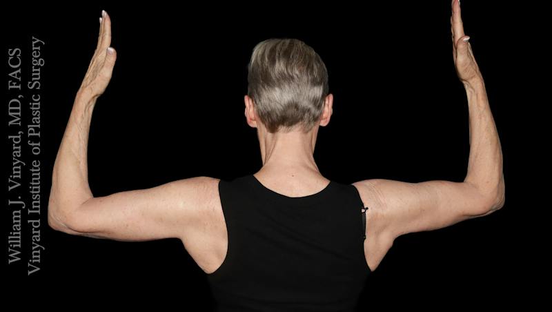 Arm Lift Before & After Gallery - Patient 189128 - Image 6